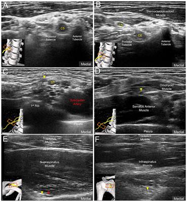 Basis of Shoulder Nerve Entrapment Syndrome: An Ultrasonographic Study Exploring Factors Influencing Cross-Sectional Area of the Suprascapular Nerve